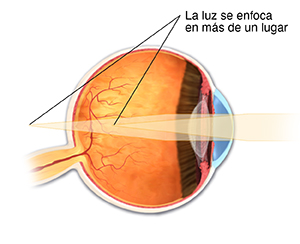 Corte transversal de un ojo que muestra astigmatismo.