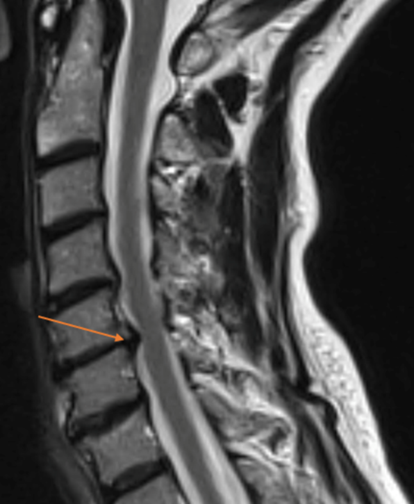 MRI image of ruptured disc in Linda’s neck